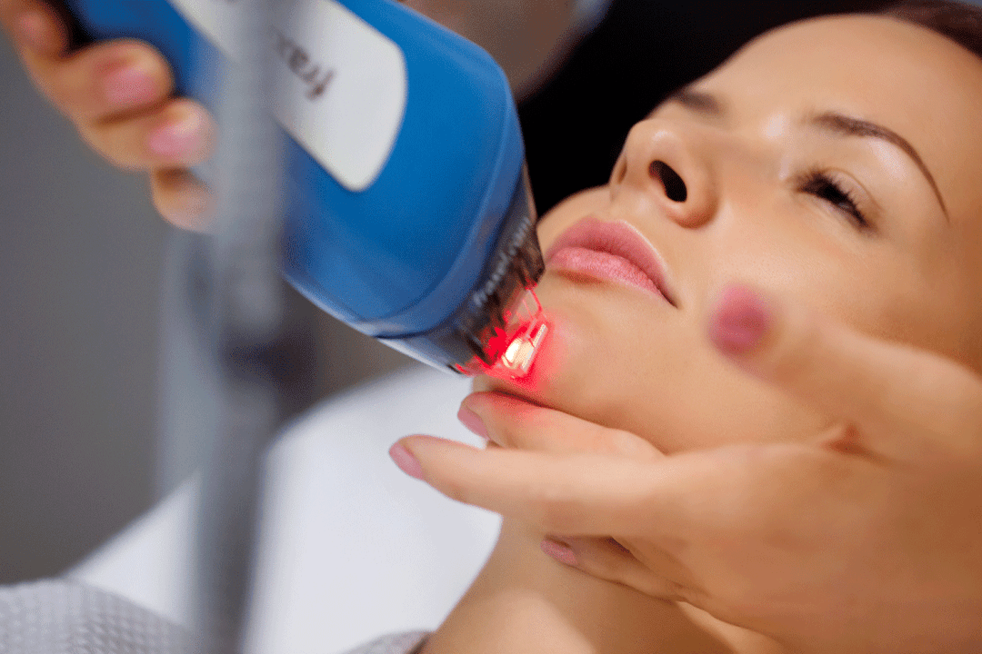 întinerirea pielii faciale cu laser