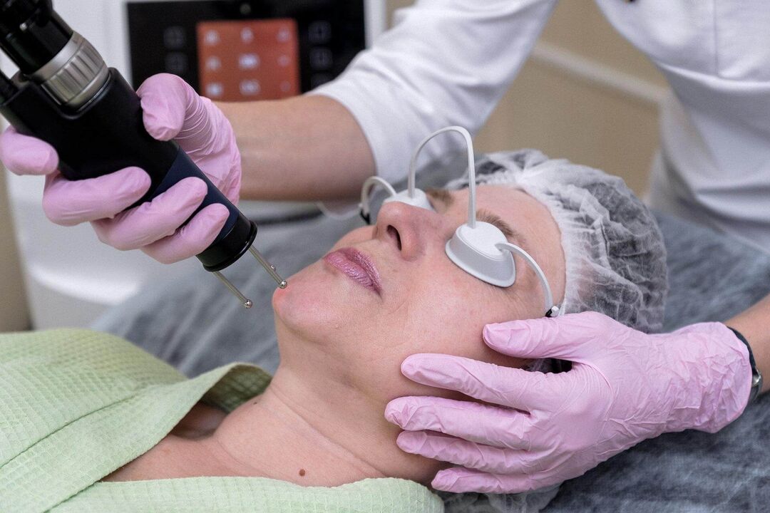 Procedura de întinerire a pielii cu laser ablativ