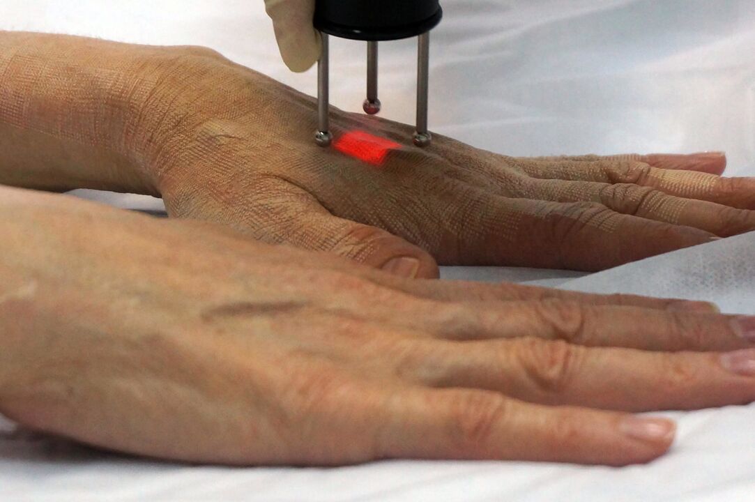 Întinerirea cu laser a mâinilor cu o metodă non-ablativă