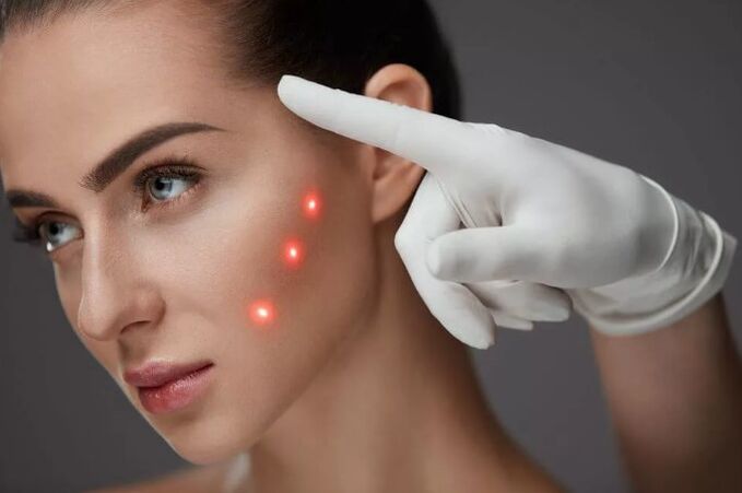 Întinerirea laserului pielii