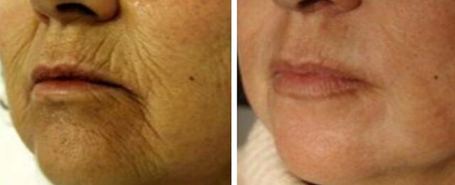 Rejuvenarea 4d