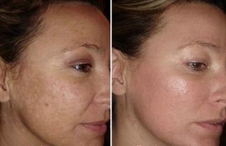 întinerire a pielii faciale cu laser înainte și după fotografii